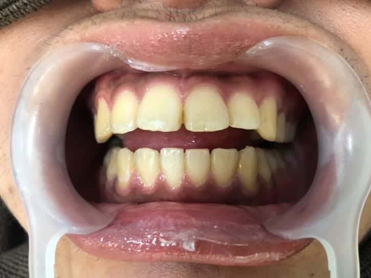 スターホワイトニング_器具_ホワイトニング前