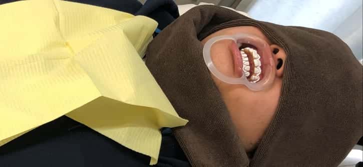 スターホワイトニング_LED照射前