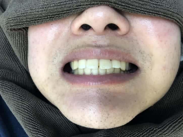 スターホワイトニング_ホワイトニング後