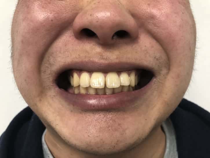 ホワイトニング_前_歯