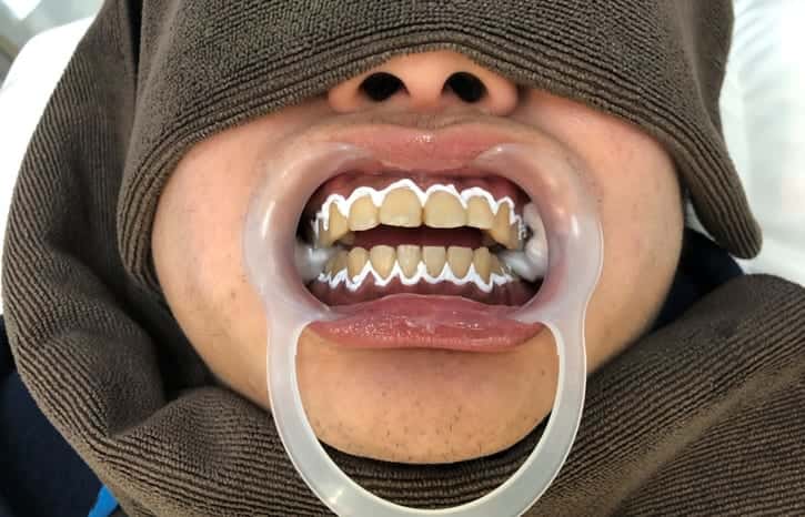 スターホワイトニング_歯茎_保護クリーム