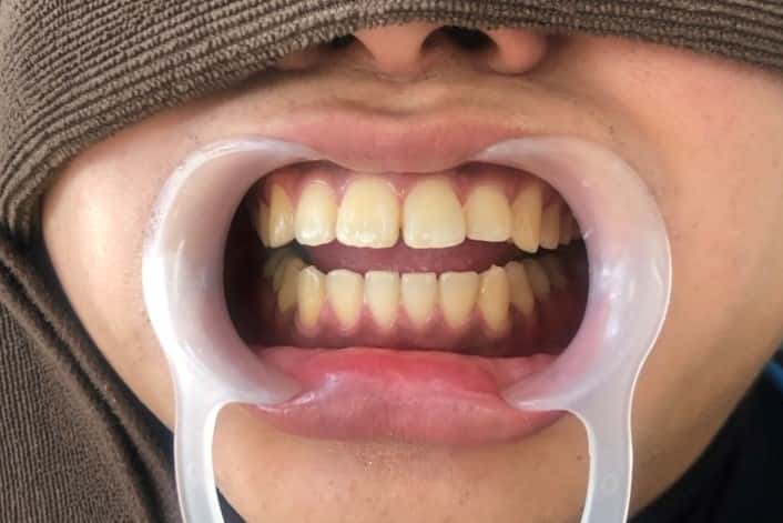 ホワイトニング体験2回目後