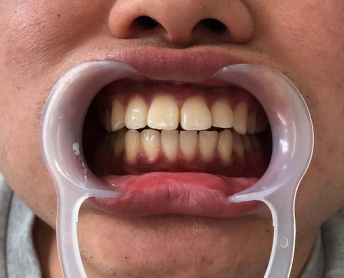 ホワイトニング体験3回目後