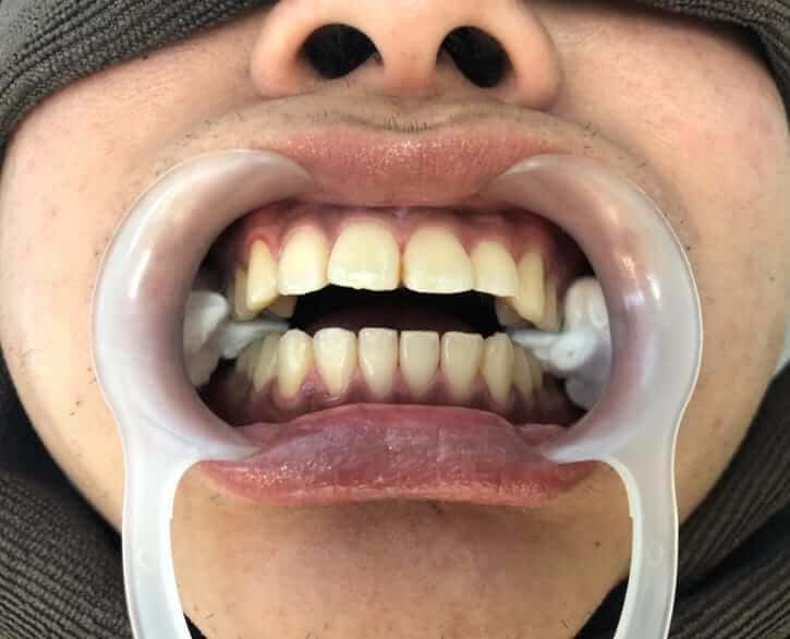 ホワイトニング体験4回目後