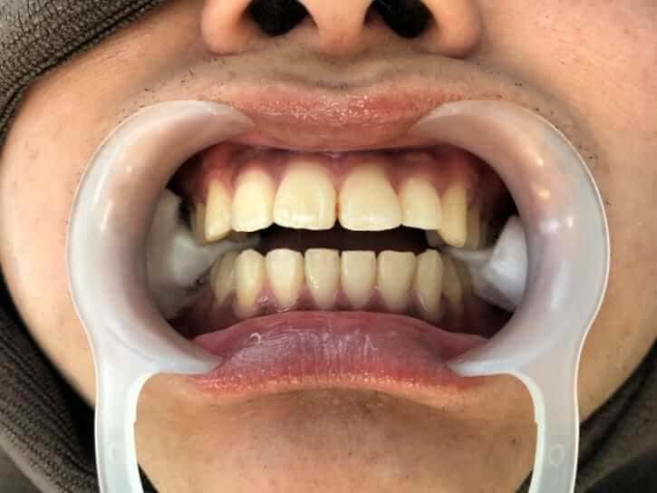 ホワイトニング体験5回目後